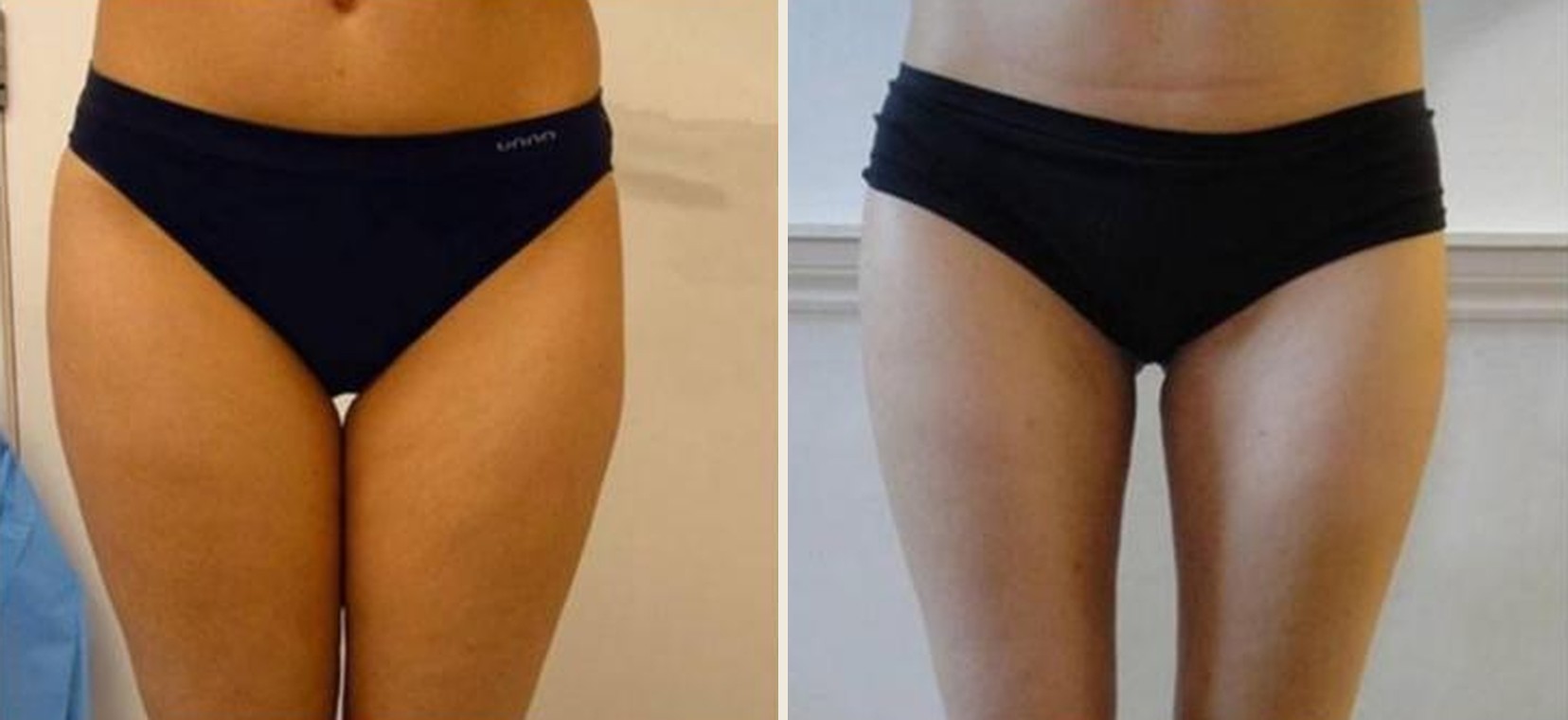 Before and after laser liposuction of the thighs, front view