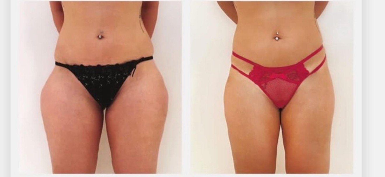 Before and after laser liposuction of hips and thighs, front view